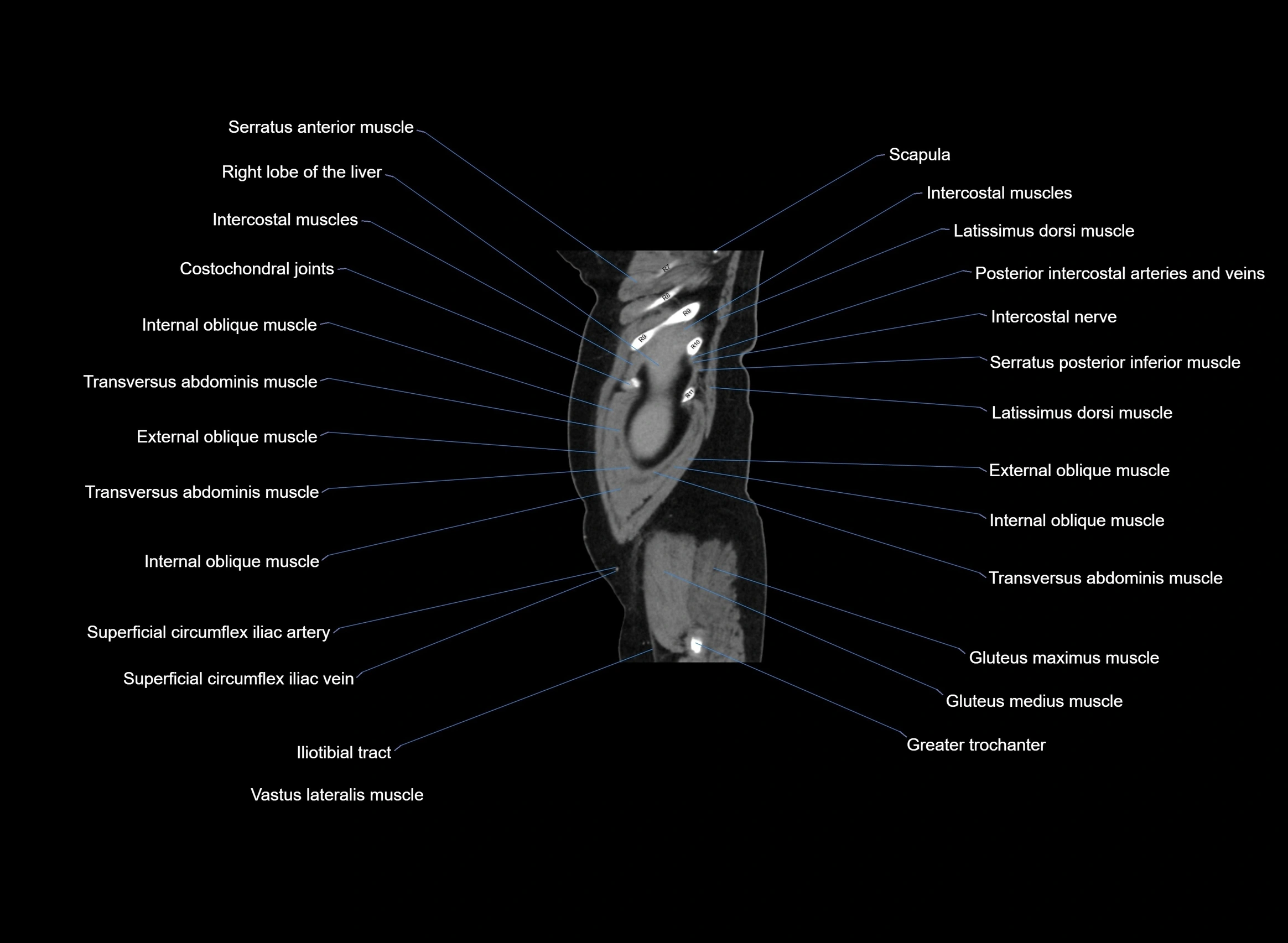 CT Abdomen sagittal cross sectional anatomy labelled radiology image -00103.webp